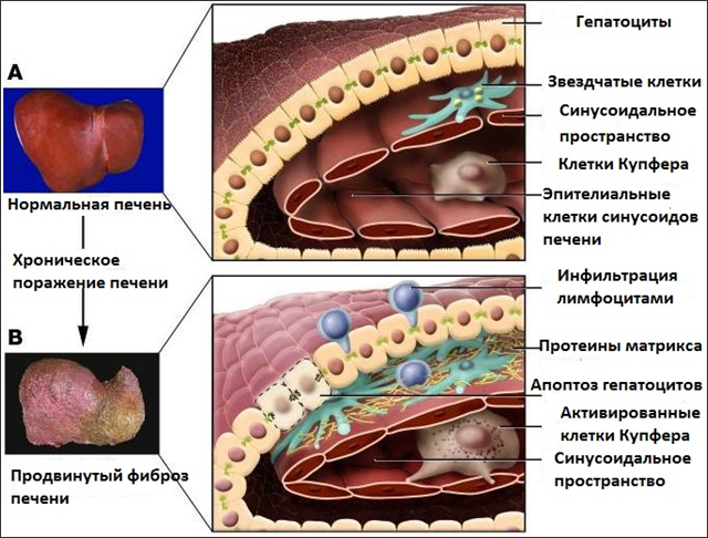Фиброз печени наглядная иллюстрация