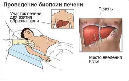 Биопсия печени - как выполняется процедура. Участок печени пациента, из которого берется образец  ткани при биопсии печени.