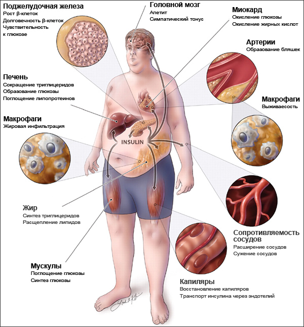 Общая картина метаболического синдрома