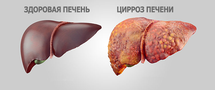 Цирроз печени Печень с признаками цирроза