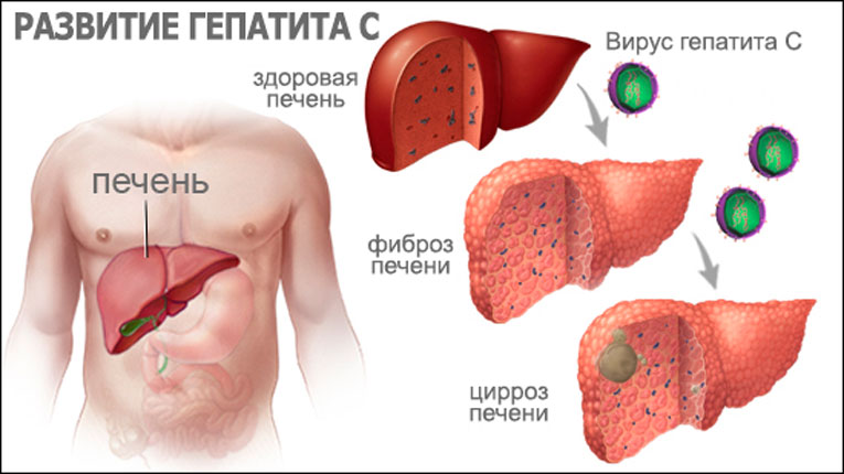 Развитие хронического гепатита С