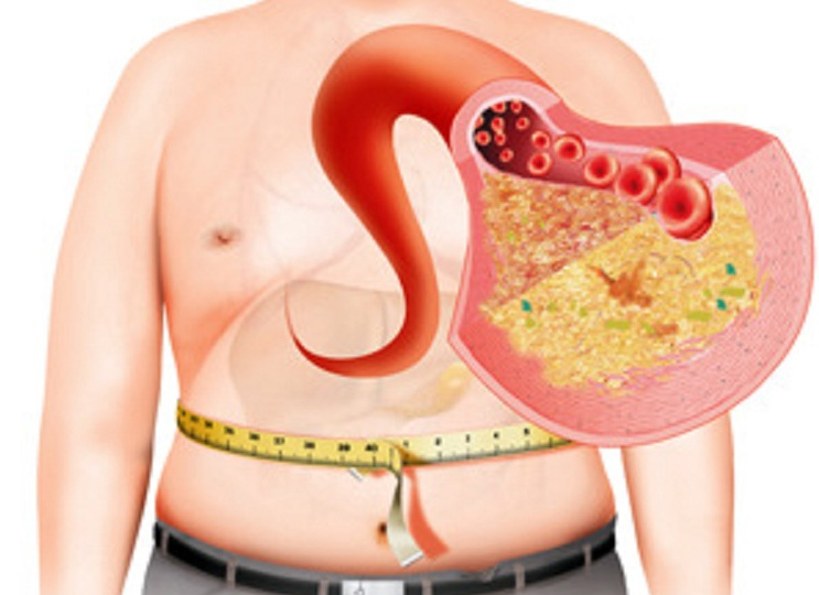 Метаболический синдром сопровождается жировым гепатозом