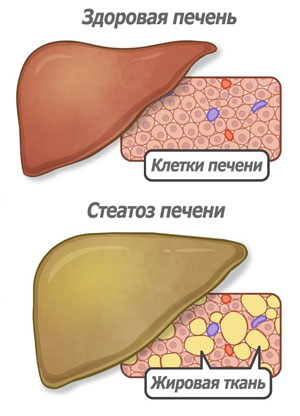 Диффузный стеатоз печени: причины, симптомы и лечение стеатоза